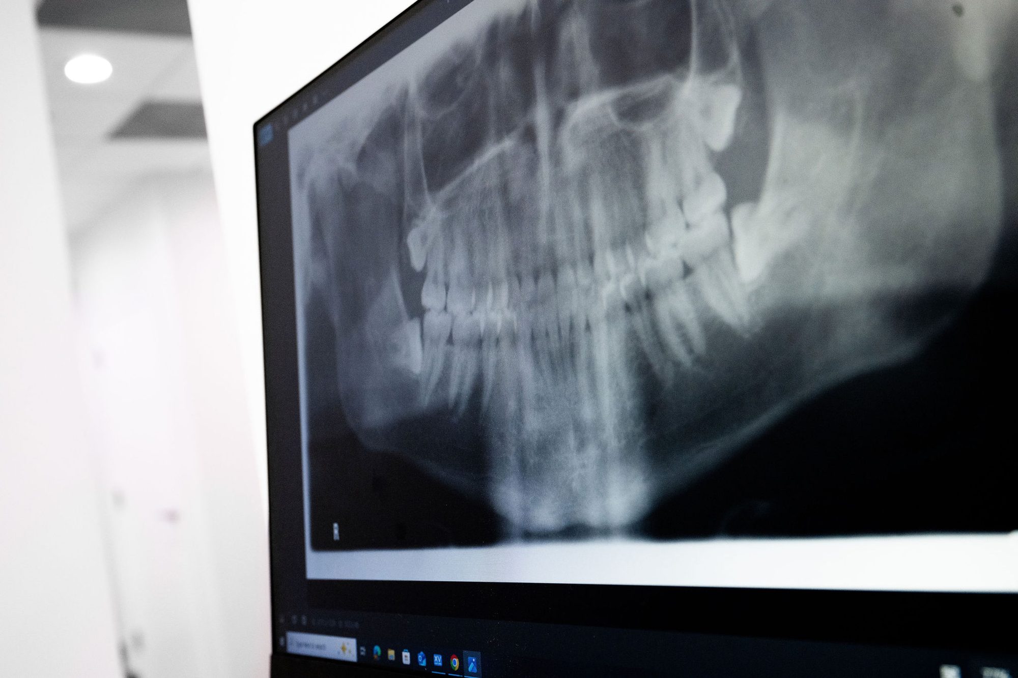 Dental X-ray showing infection at a tooth root before treatment